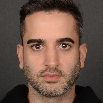 Male Rhinoplasty Before & After Gallery - Patient 216236 - Image 1
