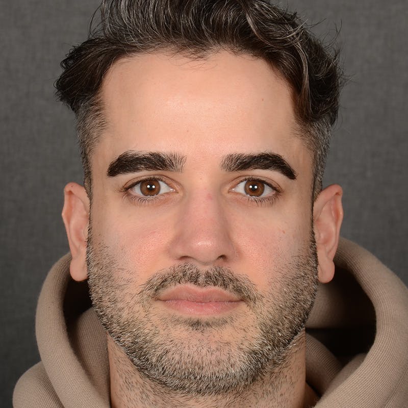 Male Rhinoplasty Before & After Gallery - Patient 216236 - Image 2