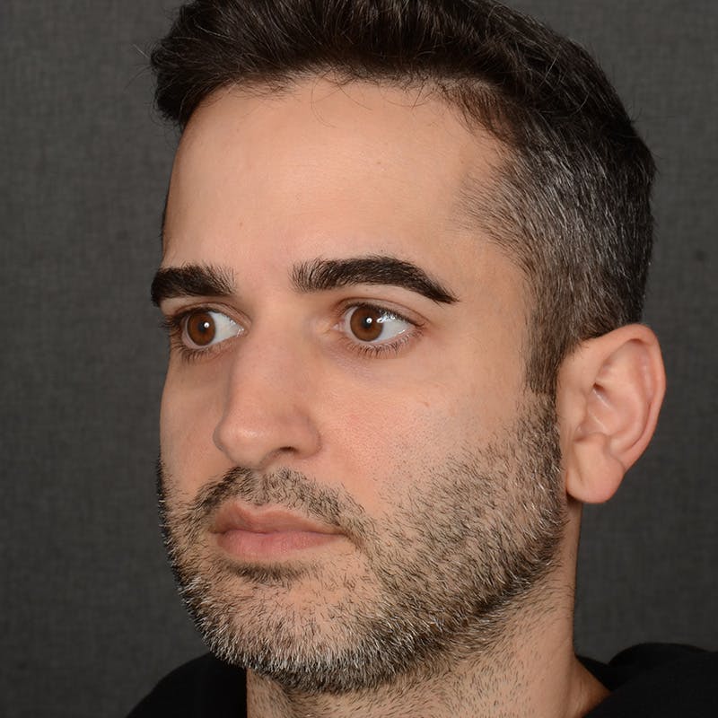 Male Rhinoplasty Before & After Gallery - Patient 216236 - Image 3