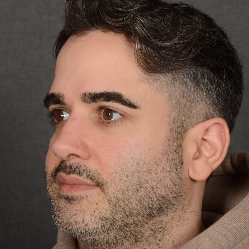 Male Rhinoplasty Before & After Gallery - Patient 216236 - Image 4