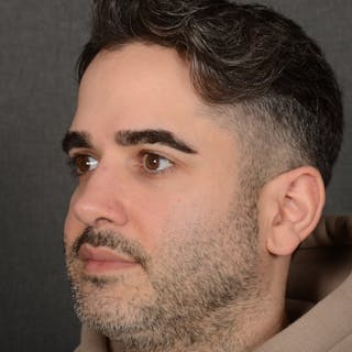 Male Rhinoplasty Before & After Gallery - Patient 216236 - Image 4