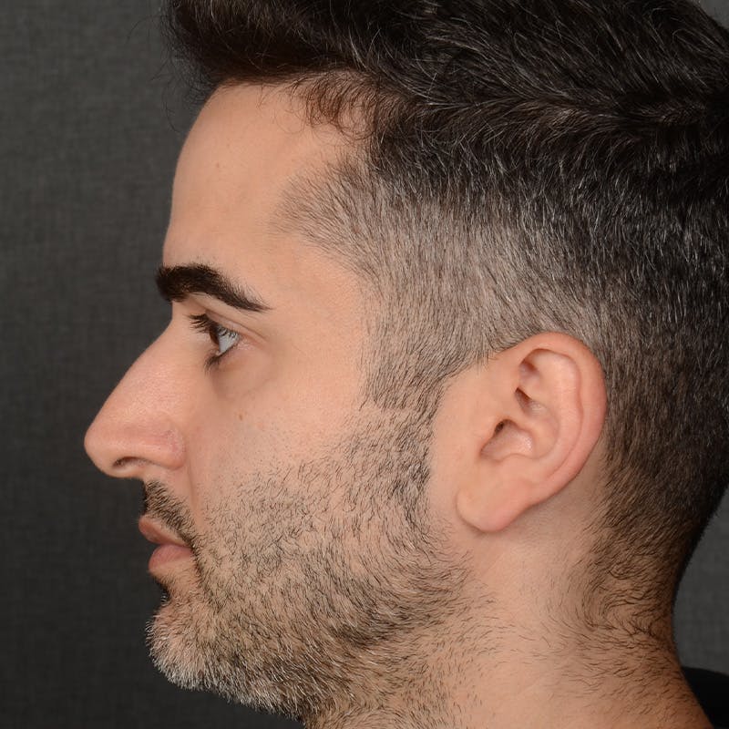 Male Rhinoplasty Before & After Gallery - Patient 216236 - Image 5