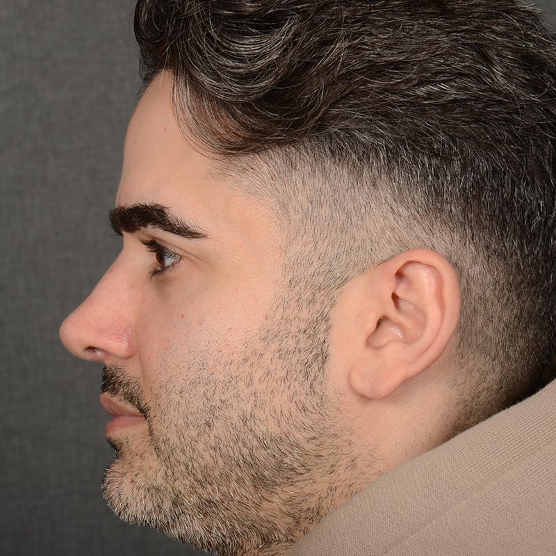 Male Rhinoplasty Before & After Gallery - Patient 216236 - Image 6