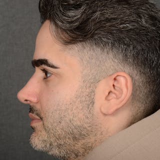 Male Rhinoplasty Before & After Gallery - Patient 216236 - Image 6