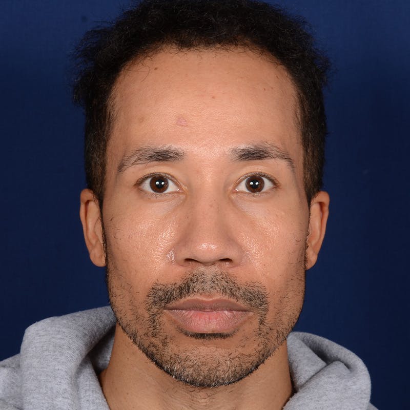 Male Rhinoplasty Before & After Gallery - Patient 328395 - Image 1