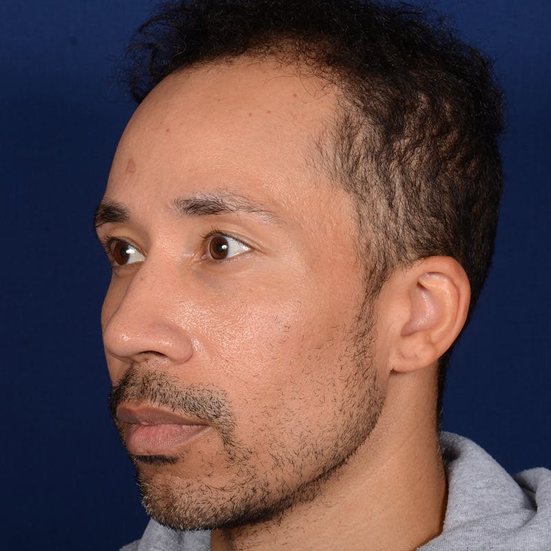 Male Rhinoplasty Before & After Gallery - Patient 328395 - Image 4