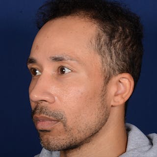 Male Rhinoplasty Before & After Gallery - Patient 328395 - Image 4