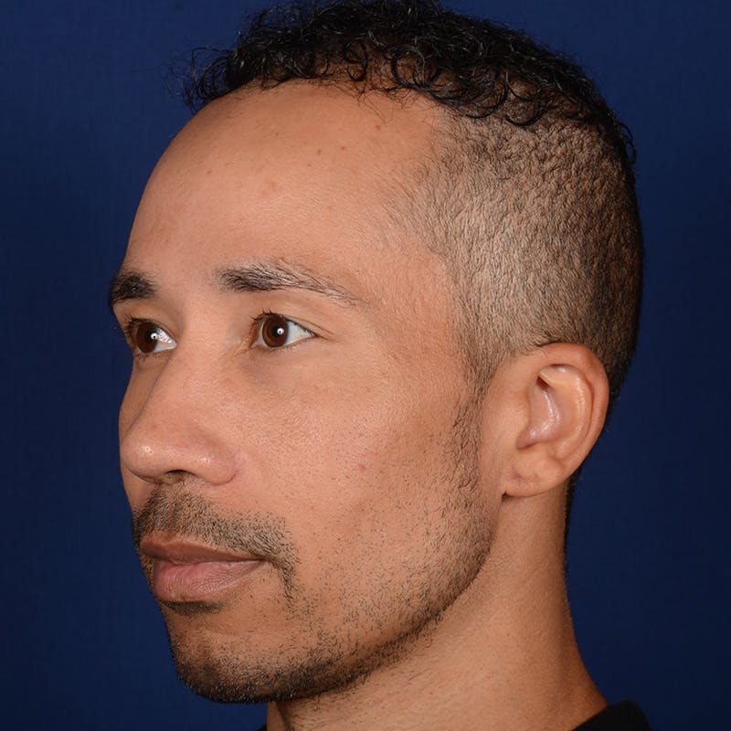 Male Rhinoplasty Before & After Gallery - Patient 328395 - Image 3