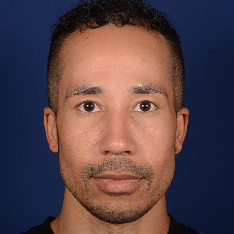 Male Rhinoplasty Before & After Gallery - Patient 328395 - Image 2