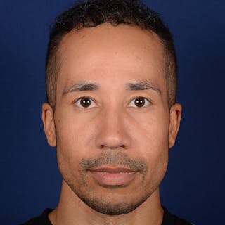 Male Rhinoplasty Before & After Gallery - Patient 328395 - Image 2