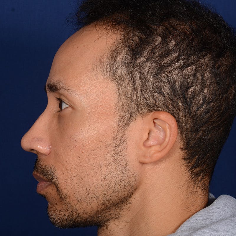 Male Rhinoplasty Before & After Gallery - Patient 328395 - Image 6