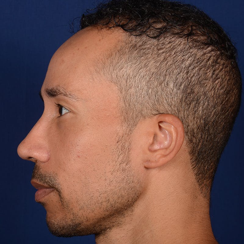 Male Rhinoplasty Before & After Gallery - Patient 328395 - Image 5