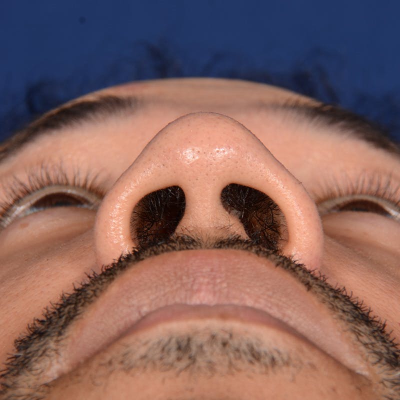 Male Rhinoplasty Before & After Gallery - Patient 328395 - Image 7