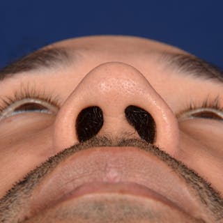 Male Rhinoplasty Before & After Gallery - Patient 328395 - Image 8