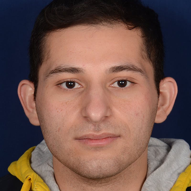 Male Rhinoplasty Before & After Gallery - Patient 818074 - Image 1