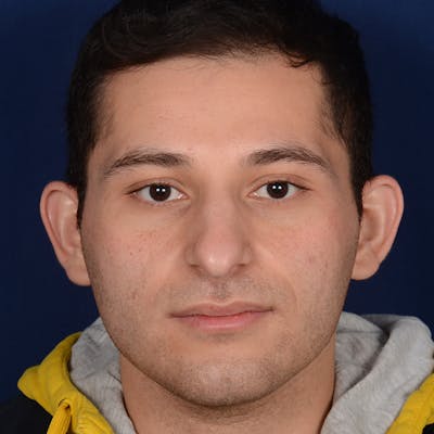 Male Rhinoplasty Before & After Gallery - Patient 818074 - Image 1