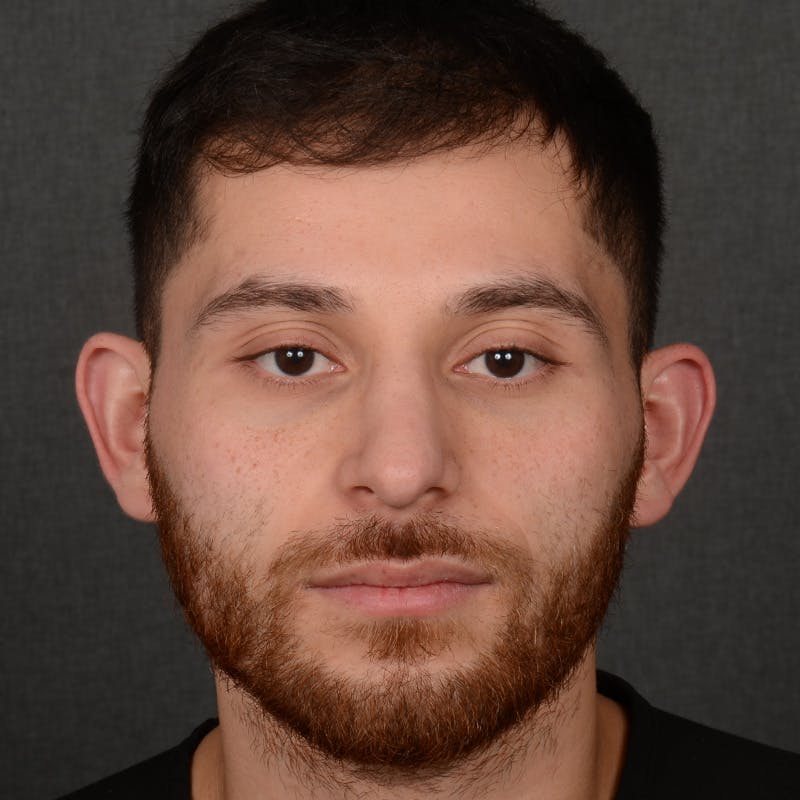 Male Rhinoplasty Before & After Gallery - Patient 818074 - Image 2