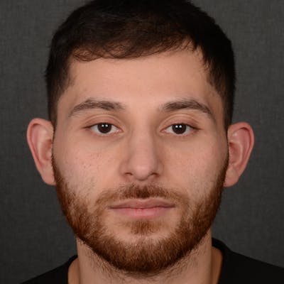 Male Rhinoplasty Before & After Gallery - Patient 818074 - Image 2