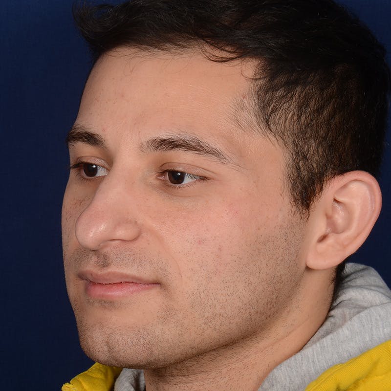 Male Rhinoplasty Before & After Gallery - Patient 818074 - Image 3