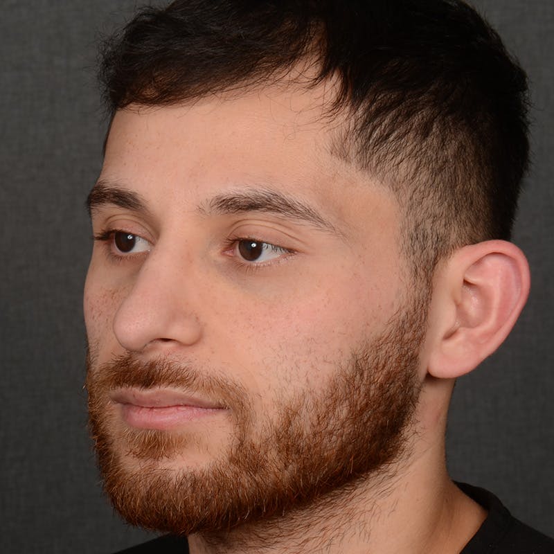 Male Rhinoplasty Before & After Gallery - Patient 818074 - Image 4