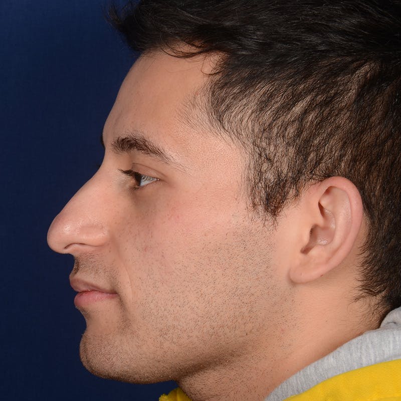 Male Rhinoplasty Before & After Gallery - Patient 818074 - Image 5