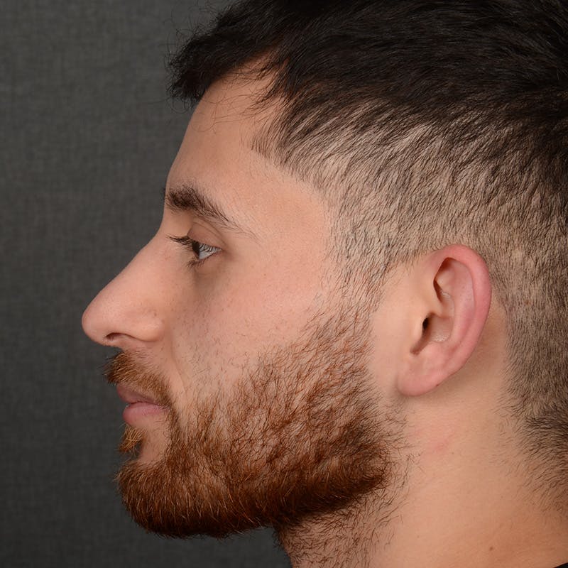 Male Rhinoplasty Before & After Gallery - Patient 818074 - Image 6