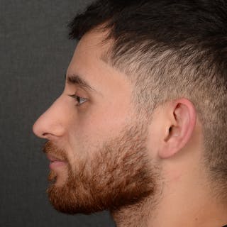 Male Rhinoplasty Before & After Gallery - Patient 818074 - Image 6