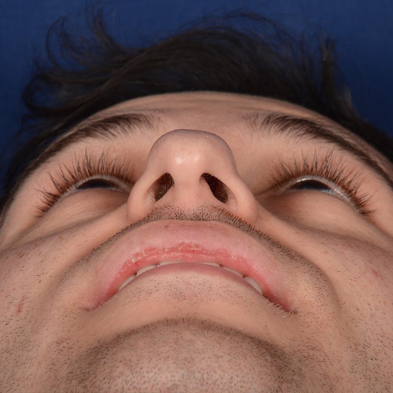 Male Rhinoplasty Before & After Gallery - Patient 818074 - Image 7