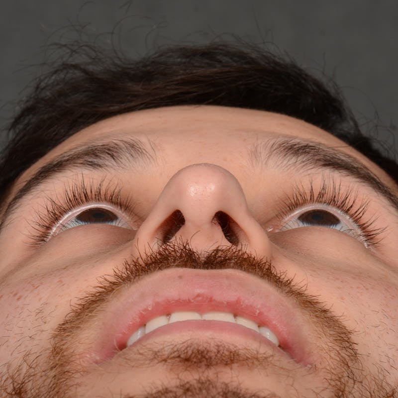 Male Rhinoplasty Before & After Gallery - Patient 818074 - Image 8