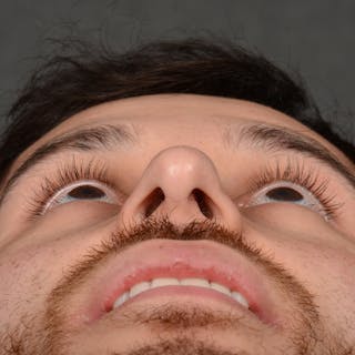 Male Rhinoplasty Before & After Gallery - Patient 818074 - Image 8