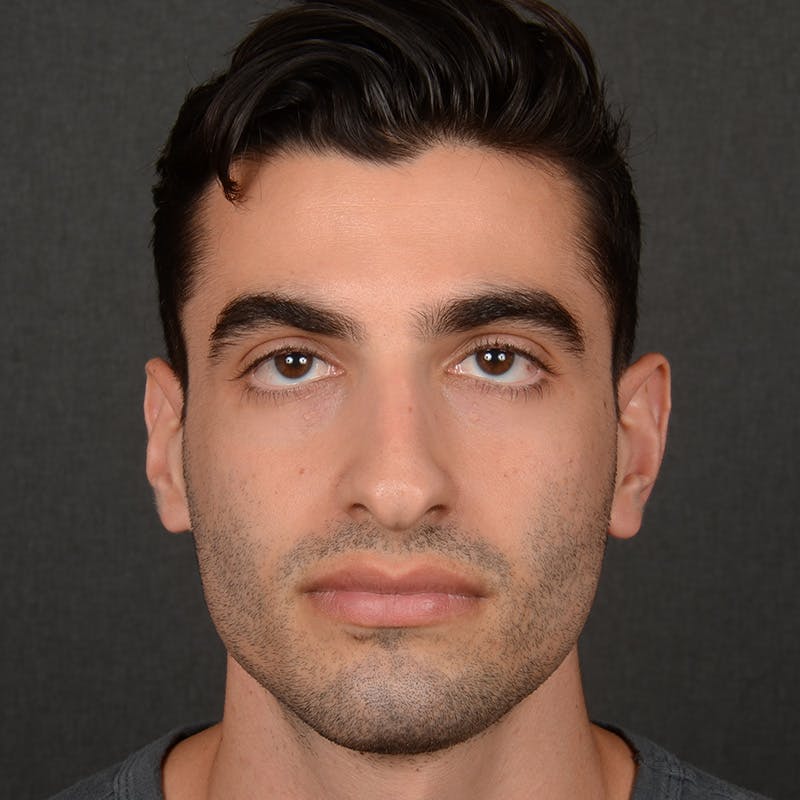 Male Rhinoplasty Before & After Gallery - Patient 340246 - Image 1