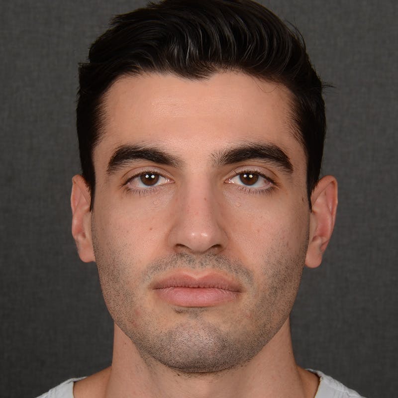 Male Rhinoplasty Before & After Gallery - Patient 340246 - Image 2