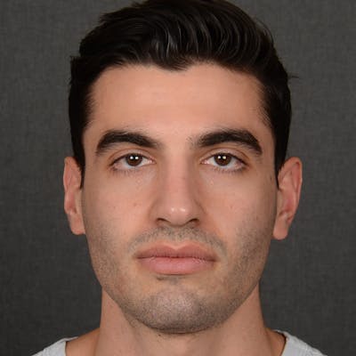 Male Rhinoplasty Before & After Gallery - Patient 340246 - Image 2