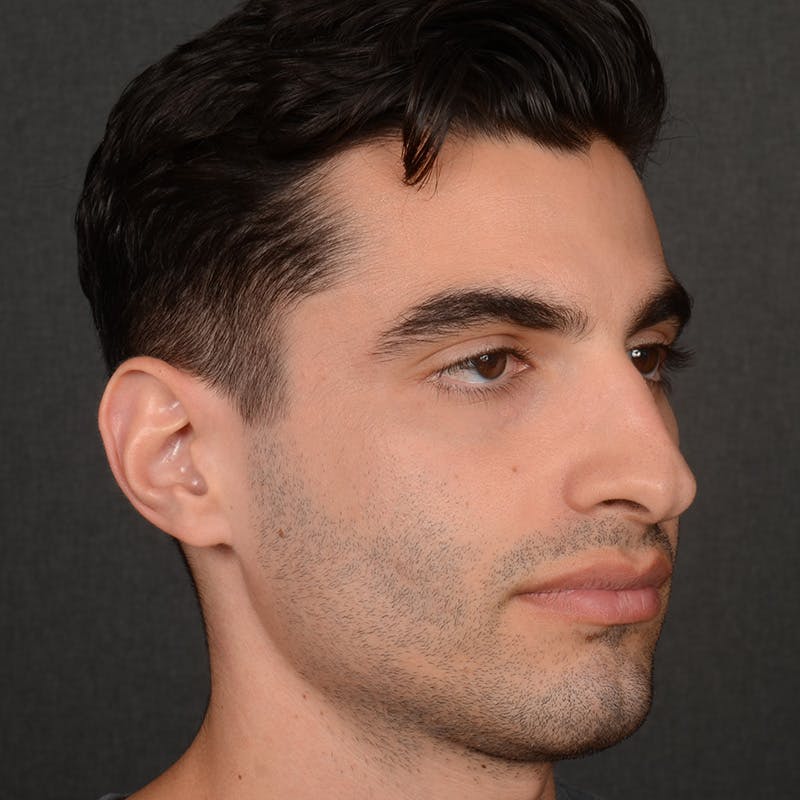 Male Rhinoplasty Before & After Gallery - Patient 340246 - Image 3