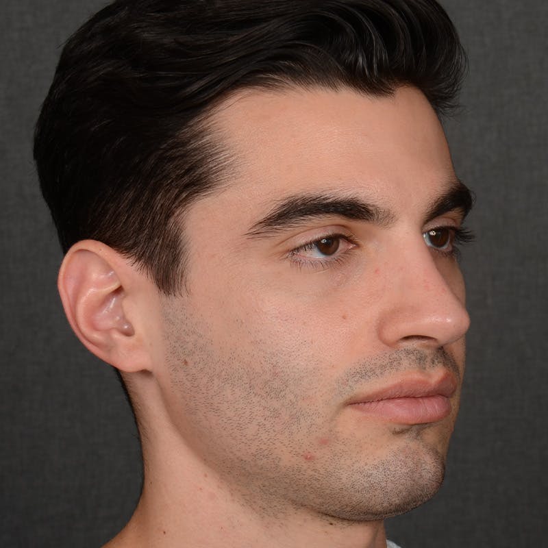 Male Rhinoplasty Before & After Gallery - Patient 340246 - Image 4