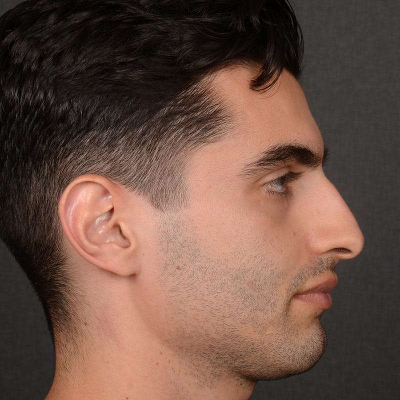 Male Rhinoplasty Before & After Gallery - Patient 340246 - Image 5
