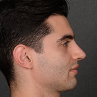 Male Rhinoplasty Before & After Gallery - Patient 340246 - Image 6