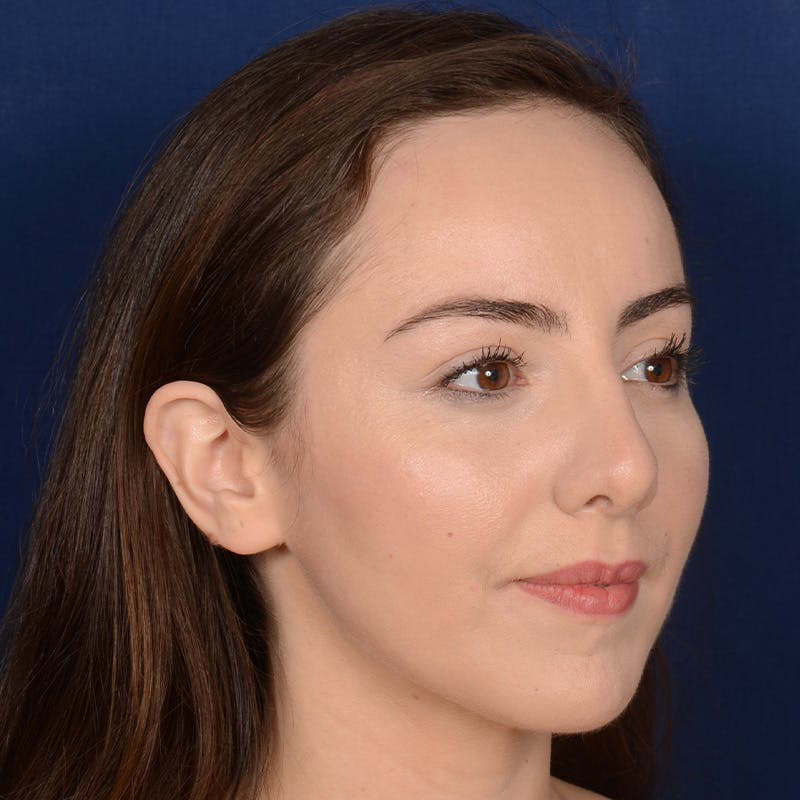 Corrective / Revision Rhinoplasty Before & After Gallery - Patient 110847 - Image 3