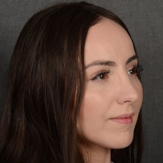 Corrective / Revision Rhinoplasty Before & After Gallery - Patient 110847 - Image 4