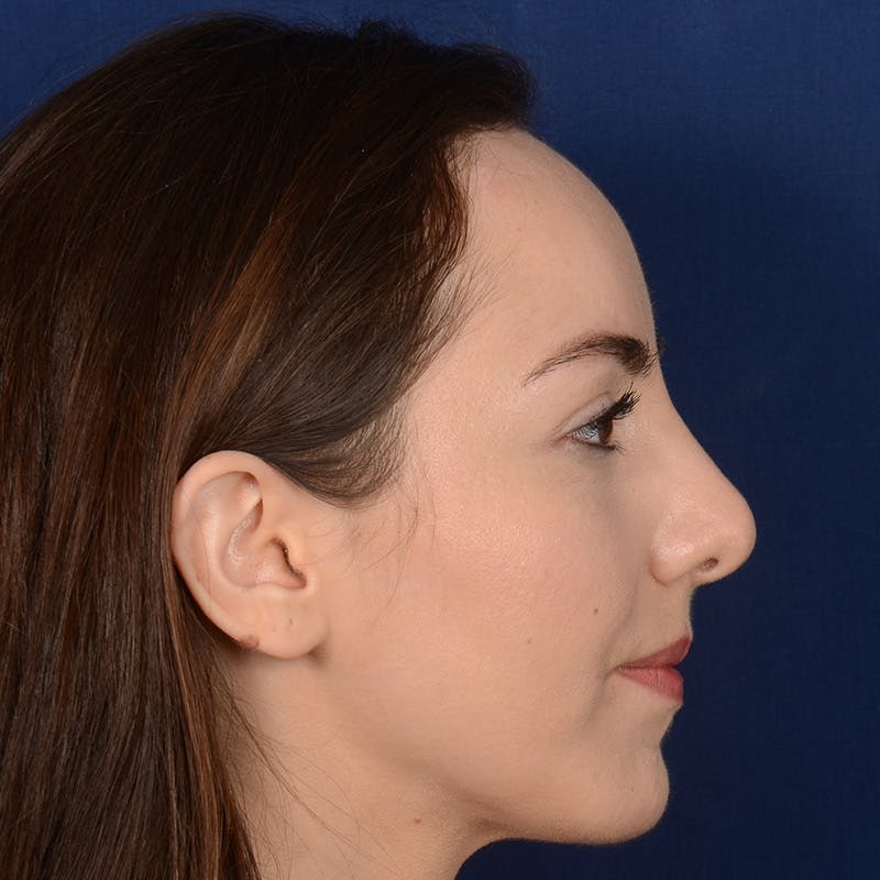 Corrective / Revision Rhinoplasty Before & After Gallery - Patient 110847 - Image 5