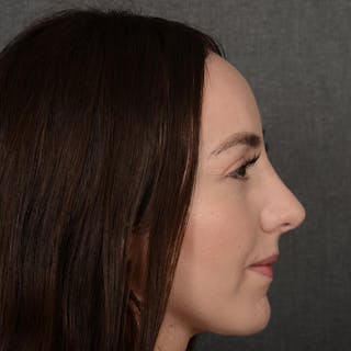 Corrective / Revision Rhinoplasty Before & After Gallery - Patient 110847 - Image 6