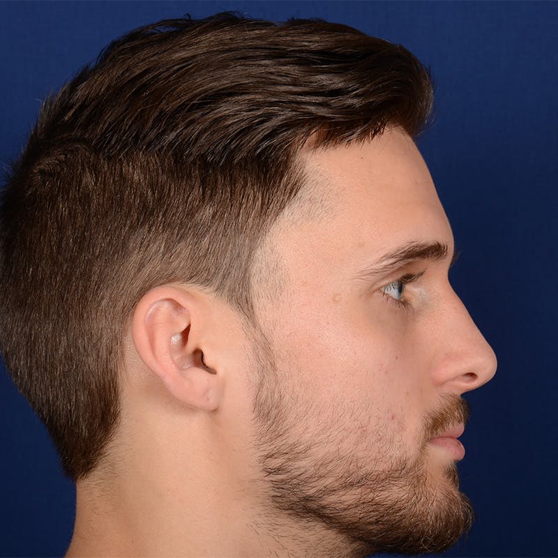 Male Rhinoplasty Before & After Gallery - Patient 915882 - Image 5