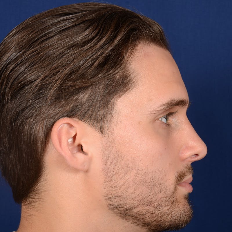 Male Rhinoplasty Before & After Gallery - Patient 915882 - Image 6