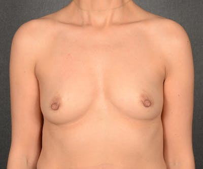 Breast Augmentation Before & After Gallery - Patient 694158 - Image 1