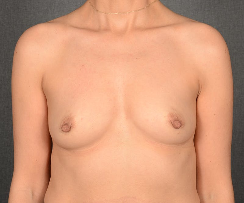 Breast Augmentation Before & After Gallery - Patient 694158 - Image 1