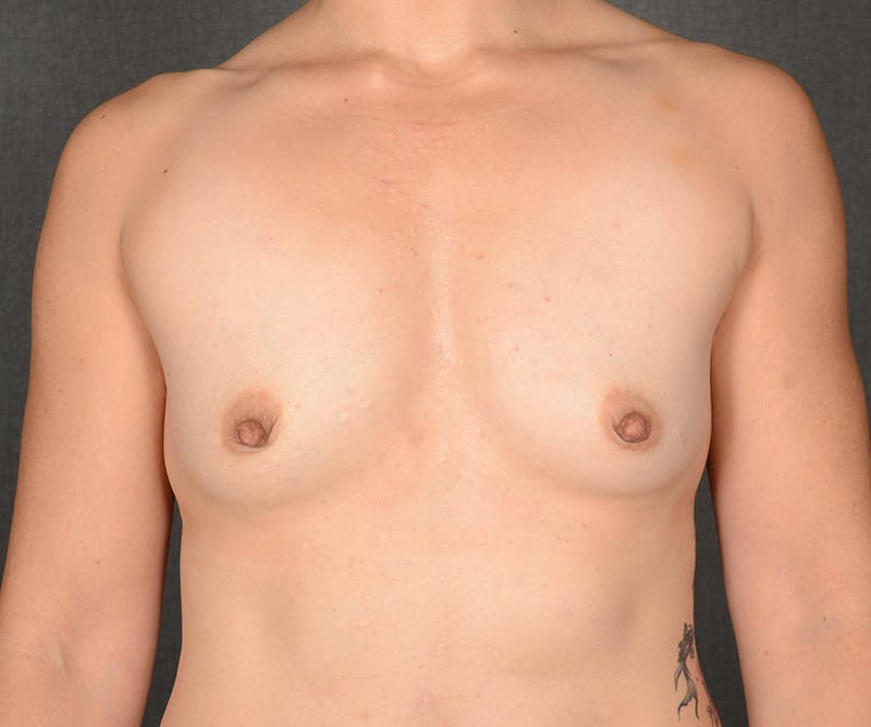 Breast Augmentation Before & After Gallery - Patient 370150 - Image 1