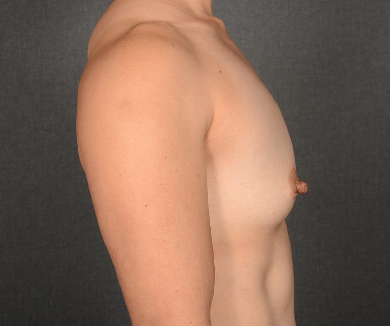 Breast Augmentation Before & After Gallery - Patient 370150 - Image 5
