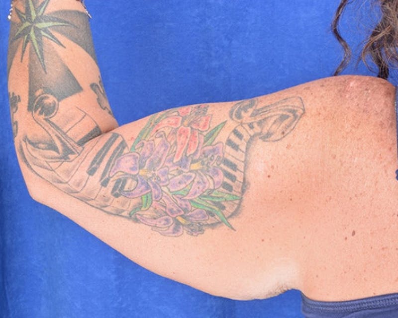 Arm Lift Before & After Gallery - Patient 997289 - Image 1
