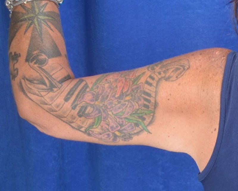 Arm Lift Before & After Gallery - Patient 997289 - Image 2