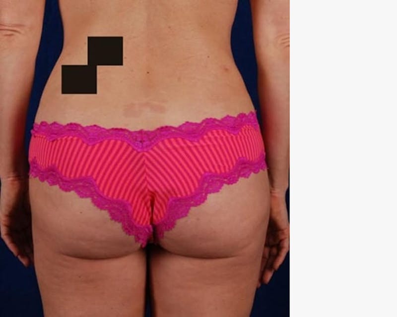Liposuction Before & After Gallery - Patient 382641 - Image 4